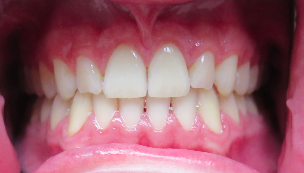 close up of front teeth showing teeth spacing improvements after SureSmile clear aligner therapy orthodontist presedure
