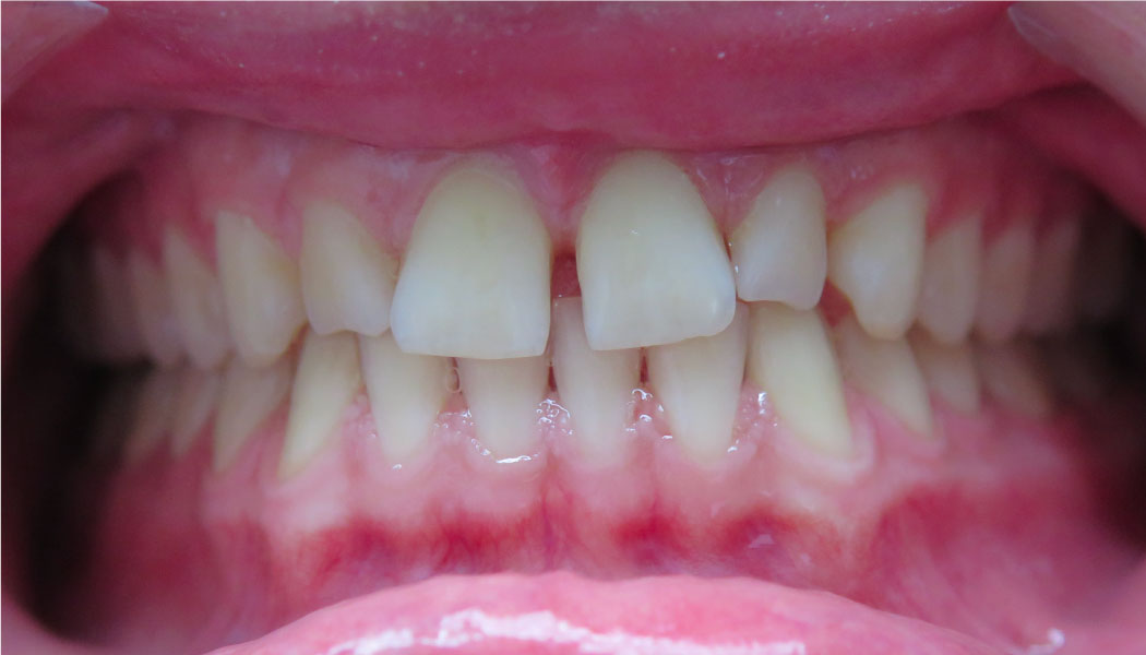 close up of front teeth before SureSmile clear aligner therapy orthodontist presedure