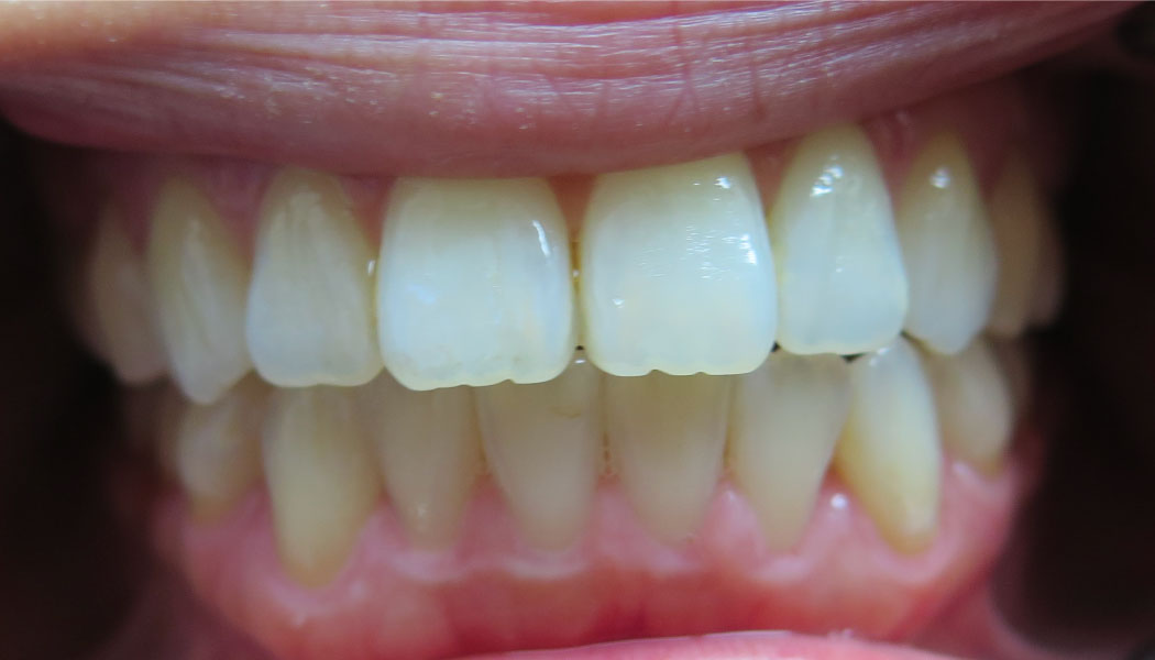 close up of front teeth showing teeth alignment improvements after SureSmile clear aligner therapy orthodontist presedure