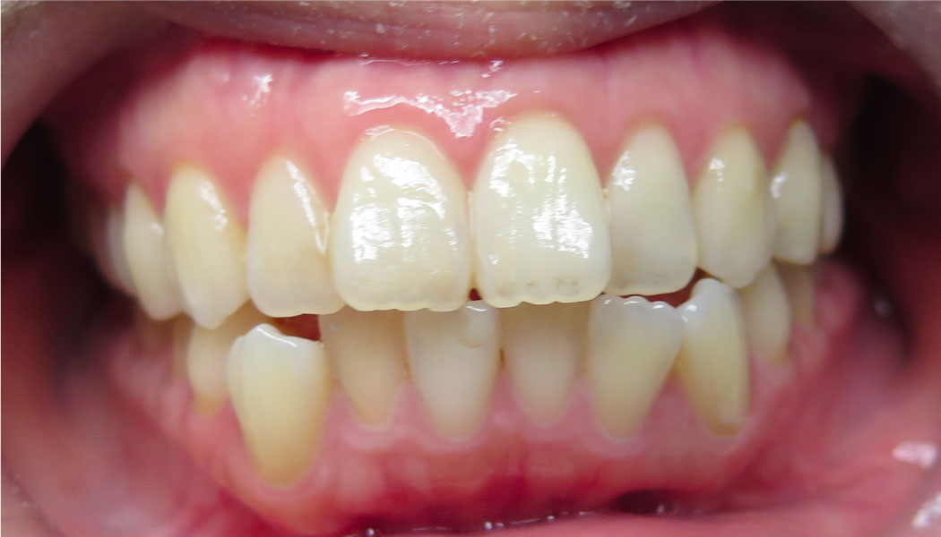 close up of crooked front teeth before SureSmile clear aligner therapy orthodontist presedure