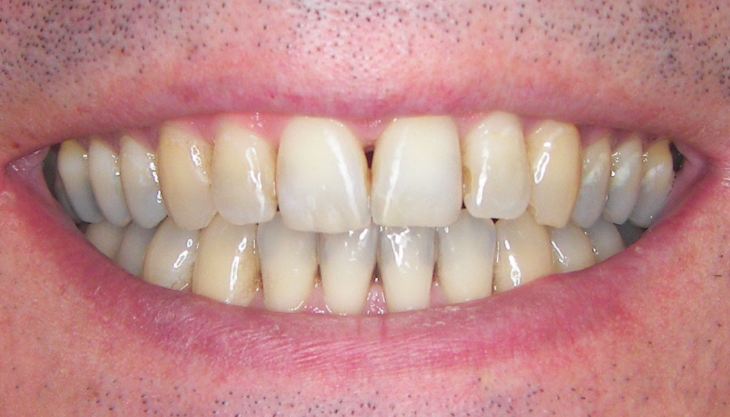 close up of front teeth showing teeth spacing improvements after SureSmile clear aligner therapy orthodontist presedure