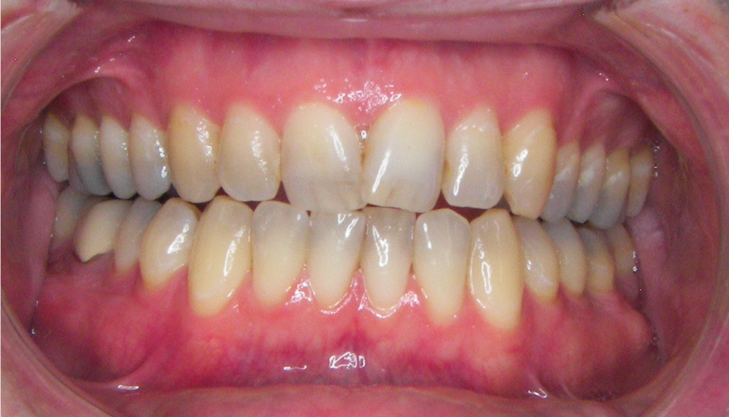 close up of crooked front teeth before SureSmile clear aligner therapy orthodontist presedure
