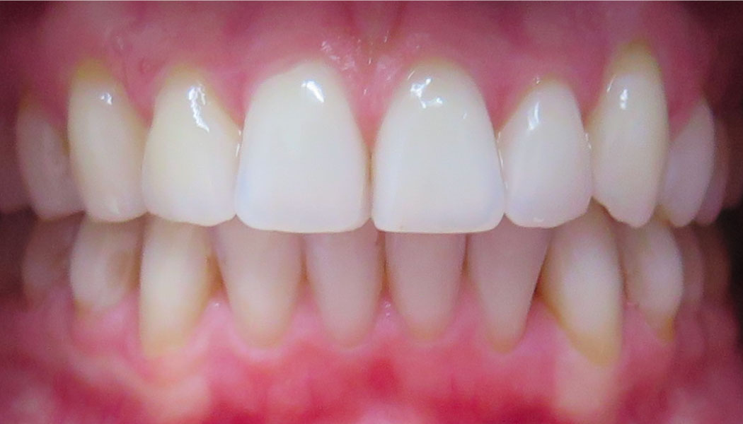 close up of front teeth showing teeth spacing improvements after SureSmile clear aligner therapy orthodontist presedure