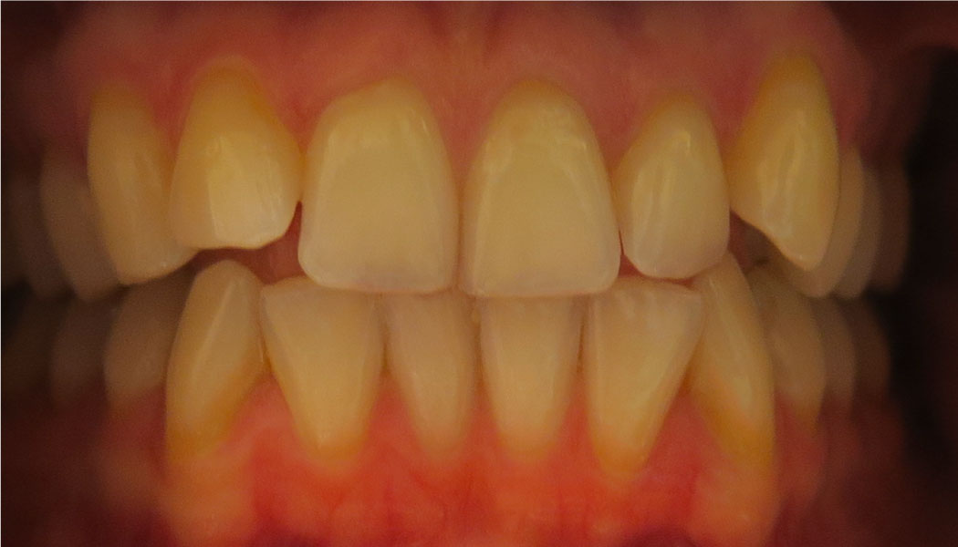 close up of crooked front teeth before SureSmile clear aligner therapy orthodontist presedure